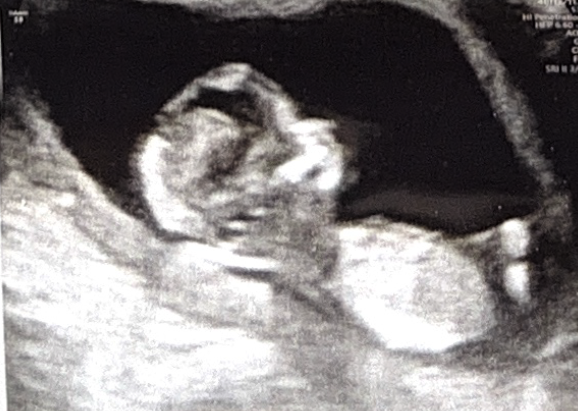 Ultrasound at 13 weeks